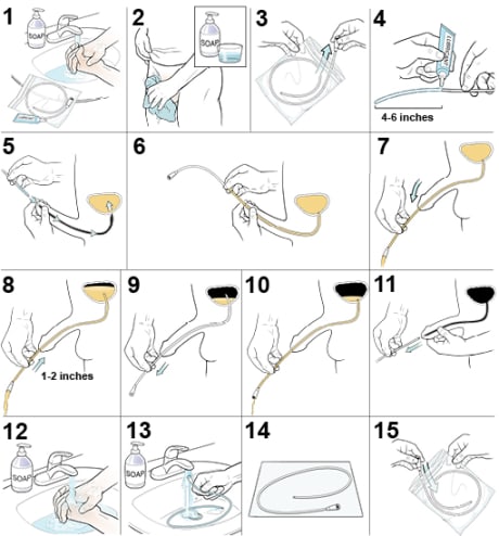 15 steps showing how to insert a urinary male catheter.