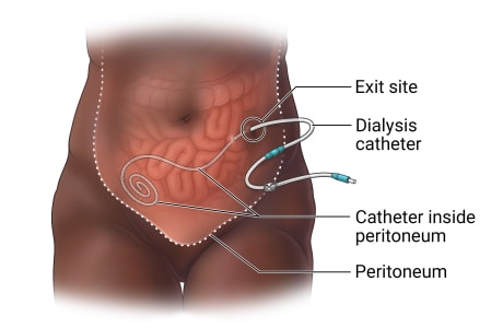 Peritoneal dialysis,  showing the peritoneum, catheter inside peritoneum, and dialysis catheter coming out of exit site in abdomen.