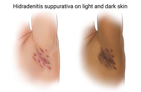 Hidradenitis suppurativa on light-skinned armpit and dark-skinned armpit.