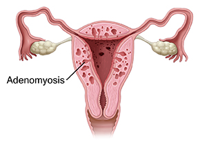Front view cross section of uterus showing adenomyosis.