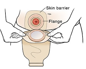 Hands placing colostomy pouch over stoma.