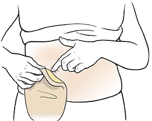 Closeup of abdomen showing hands removing colostomy pouch.