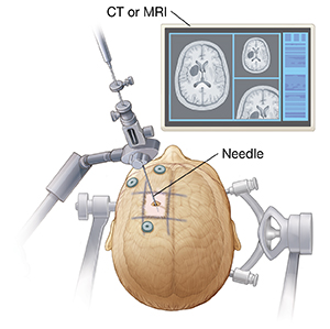 Top view of head showing biopsy needle held by mechanical arm entering small hole in top of head with clamps on either side of head. Monitor showing tumor location.