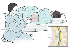 Healthcare provider inserting needle into lower spine of draped patient lying on her side. Inset shows cross section of lumbar spine with needle inserted into spinal canal.