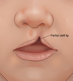 Front view of child's nose and mouth showing partial cleft lip.