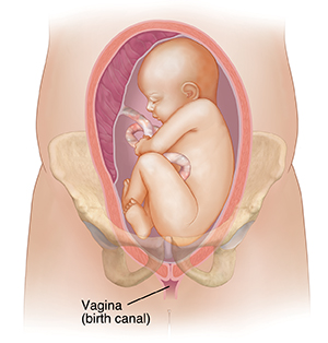 Front view cross section of uterus between pelvic bones showing fetus with head up, in breech position.