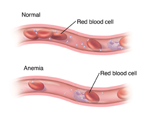 Blood vessel with normal red blood cells and blood vessel with few red blood cells due to anemia.