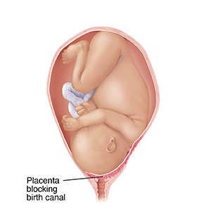 Front view of full-term fetus in uterus between pelvic bones with head down. Placenta is blocking birth canal, showing placental previa.