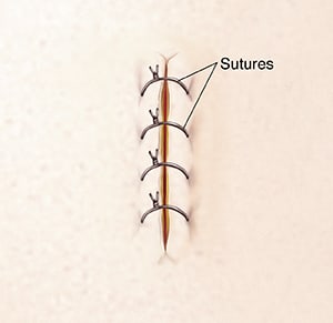 Incision closed with sutures.