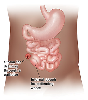 Front view of lower digestive tract with colon and rectum removed, showing stoma for permanent ileostomy. 
