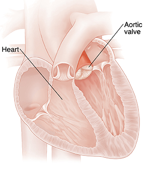 Cross section of heart showing aortic valve with stenosis.