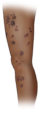 Side view of a leg with a patchy rash from thigh to calf on dark skin.