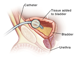 Cross section of child's pelvis showing bladder and urethra with catheter inserted through skin above pubic bone.